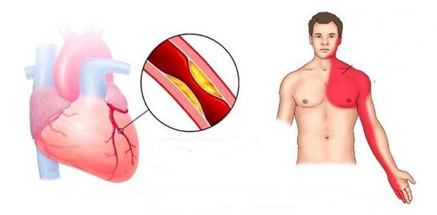 Cardial Syndrom