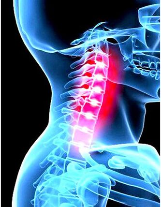 Klinisches Bild der Osteochondrose